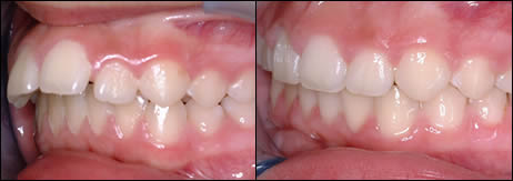 Orthodontic before and after