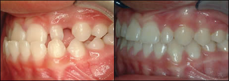 Orthodontic before and after