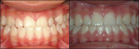 Orthodontic before and after