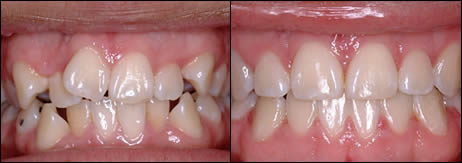 Orthodontic before and after