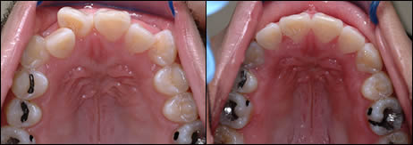 Orthodontic before and after