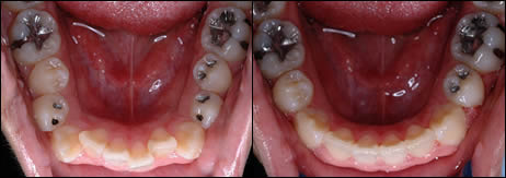 Orthodontic before and after