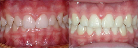 Orthodontic before and after