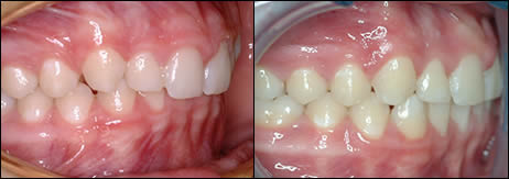 Orthodontic before and after