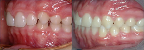 Orthodontic before and after