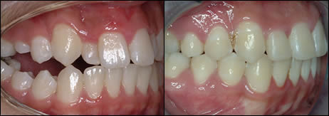 Orthodontic before and after