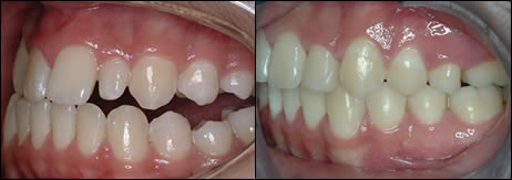 Orthodontic before and after