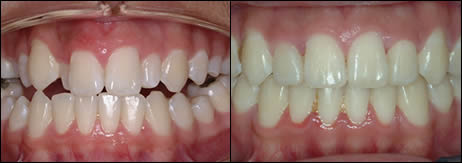 Orthodontic before and after