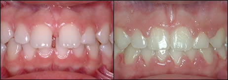 Orthodontic before and after