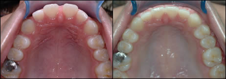 Orthodontic before and after