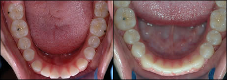 Orthodontic before and after